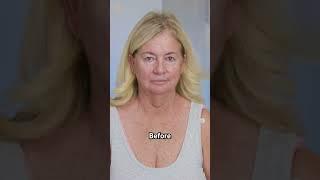 Best Deep Plane Facelift Results #deepplanefacelift #cosmeticsurgery