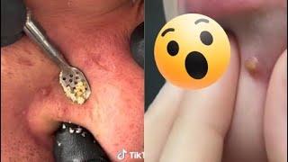 Ultimate Pimple Popping Compilation 2024 | Satisfying Blackhead & Acne Removal | Oddly Satisfying