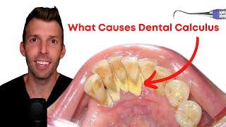 What DENTAL CALCULUS Really Means (on the Carnivore Diet)