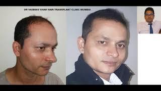 Extra-Ordinary Results of Hair Transplant by Mumbai Hair Transplant Surgeon!