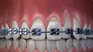 Gum Recession After Wearing Braces Can Now Be Treated Without Gum Grafting Surgery