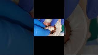 G cam durable full arch bridge (cad cam milled ) total smile makeover in 5 days for 60 yrs old women