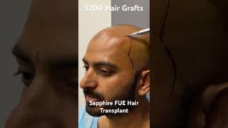 "My 5200 Grafts Hair Transplant Experience" #sapphirefue #hairtransplant