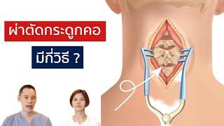 ผ่าตัดหมอนรองกระดูกคอทับเส้นประสาท มีกี่วิธี | EasyDoc  EP.36