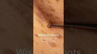 Technically called Seborrheic Keratosis #shorts #skintreatment #skingrowth #moleremoval #agespot