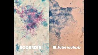 EXAM SPOTTER FOR MICROBIOLOGY | DIFFERENCE BETWEEN MYCOBACTERIUM TUBERCULOSIS & NOCARDIA