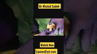 Bikini Line cysts are no fun. Dr Khaled Sadek. Full video online #cystremoval #blackheads #pimples