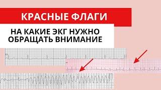 Красные флаги на ЭКГ. Жизнеугрожающие состояния. Особенности ЭКГ.