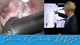 Apicoectomy on an Endo Tooth - Dental Minute with Steven T. Cutbirth, DDS