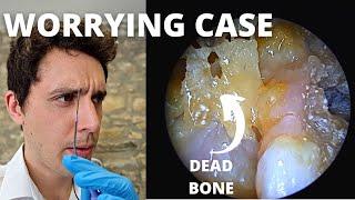 Dead Bone And Infection In Ear Cavity (Mastoid Sequestrum And Granulation)