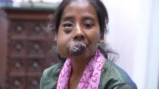 Unbelievable Face Tumor for a Young Girl