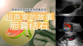 超声室的故事：胆囊结石【Ultrasound Room】Diagnosing Gallstones on Ultrasound