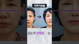 #이마거상전후 #휴고성형외과
