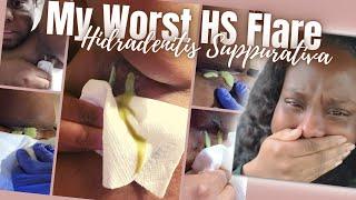 Hidradenitis Suppurativa (HS) | MY WORST Abscess | THE PAIN