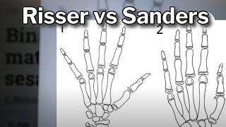 Sanders Scale vs. Risser Score: Determining Growth Potential in Scoliosis Patients