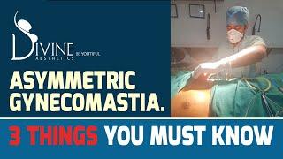 Asymmetric Gynecomastia.  3 Things You Must Know