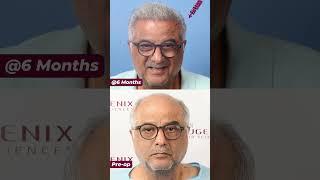 Producer Boney Kapoor's Hair Transplant 6 Months Results Update: Explained by Doctor