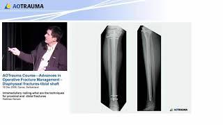 Intramed. nailing-tech. for proximal and distal fractures