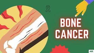 Bone Cancer, Causes, Signs and Symptoms, Diagnosis and Treatment.