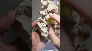 Pars Interarticularis Disruption Model with Spondylolisthesis