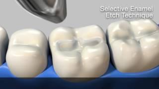 Different bonding techniques with gluma bond Universel total Etch -selective enamel -self Etch