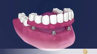 Implantology: Telescopic Crowns for a confident smile