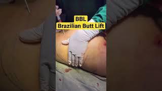 BBL | brazilian butt lift | Butt lift | Buttock lift | Butt Implant | Dr Iqbal Ahmed