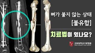 [건강정보] 뼈가 붙지 않는 상태 ‘불유합’, 어떻게 치료하나요? -고려대학교구로병원 정형외과