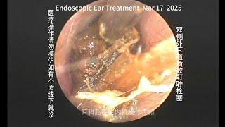 Cleaning of bilateral external auditory canal soft cerumen embolism 20250317