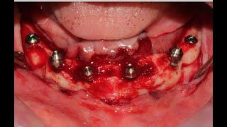 Implant Surgery: Full Arch Mandible: All-on-6