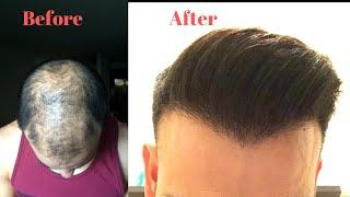 My Hair Transplant Journey