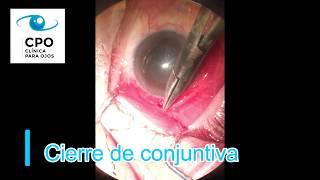 Colocación de Válvula para Glaucoma. Clínica Para Ojos.