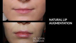 BEFORE & AFTER - Natural Lip Augmentation by Dr. Rubbani