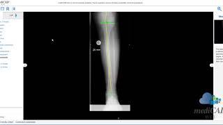 mediCAD Web 1.2 - Demovideo Knee Planning