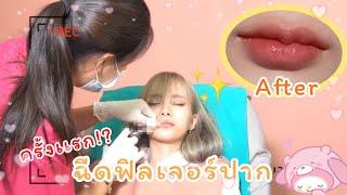 Grace zy : ฉีดฟิลเลอร์ปากครั้งเเรก?! เจ็บไหม?