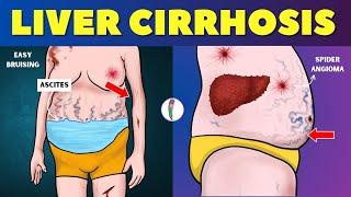 Liver cirrhosis - Warning Signs  Don't ignore these Red Flags | Chronic Liver Disease | Fatty Liver