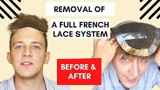 Before and After | Removal of a French Lace system