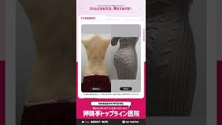 狎鴎亭トップライン大容量腹部脂肪吸引REVIEW