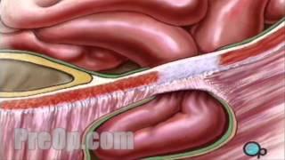 Hernia Repair Inguinal Surgery Patient Education Medical Video