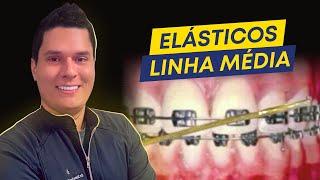 Elásticos de Linha Média : como usar do jeito certo?