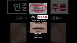 인중세로주름,2년4개월뒤 결과는? #연세자연미 #신촌성형외과 #입술고양이주름영구교정 #인중주름교정#은평성형외과