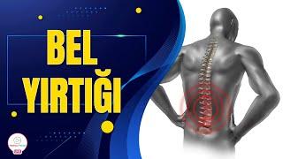 BEL YIRTIĞI / BEL YIRTIĞININ ƏLAMƏTLƏRİ / BEL YIRTIĞININ MÜALİCƏSİ / BEL AĞRISININ SƏBƏBLƏRİ