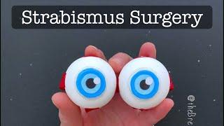 Playdough Surgery  - Strabismus Surgery