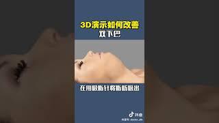 抽脂雕塑，双下巴抽脂，3D动画演示，让您更了解过程