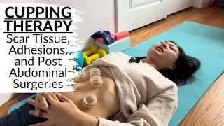 Cupping for Scar Tissue, C-Section, Adhesions, Myofascial Release