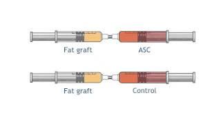 Autologous Fat Grafting