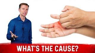 What Causes Sweaty / Dry Hands & How To Get Rid Of It? – Dr. Berg