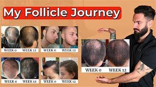 Hair Growth Program - My Follicle Journey Presentation