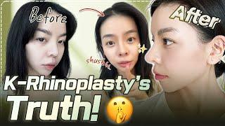 Can you believe it is my new nose...?| Nana's rhinoplasty at Braun PART 2 