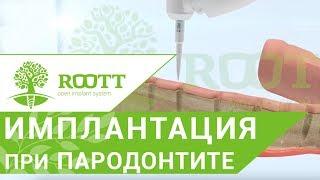 Пародонтит лечение.  Эффективное лечение пародонтита с помощью имплантации зубов. ROOTT.